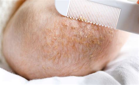 cradle cap in adults treatment.